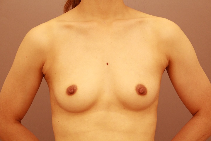 コンデンスリッチ豊胸