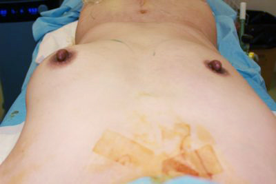 抜去後のバスト