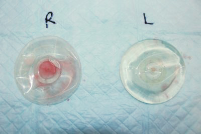 抜去したシリコンバッグ