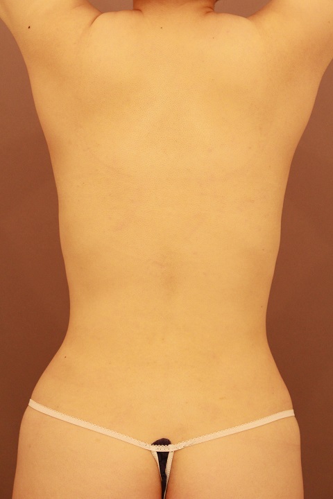 お腹・腰の脂肪吸引 術後3カ月の経過