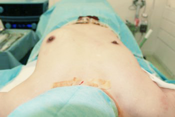 抜去後のバスト