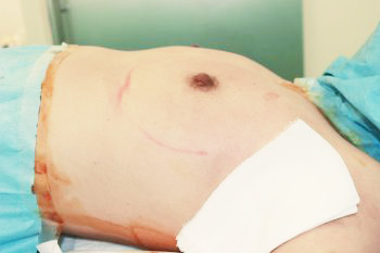 抜去後のバスト