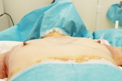 抜去後のバスト