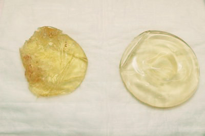 抜去したシリコンバッグ