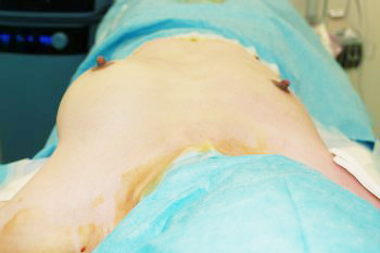 抜去後のバスト