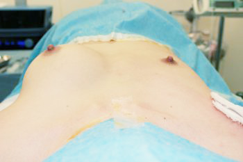 抜去後のバスト