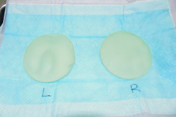 抜去したシリコンバッグ