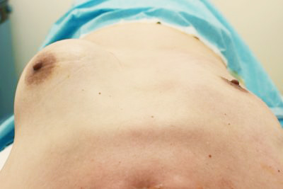 抜去後のバスト