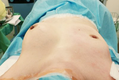 抜去後のバスト