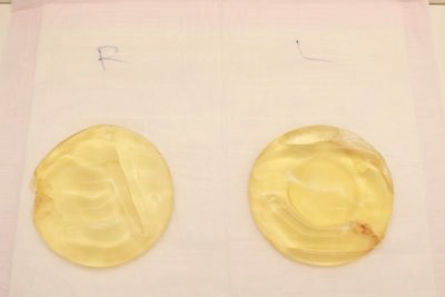 抜去したシリコンバッグ