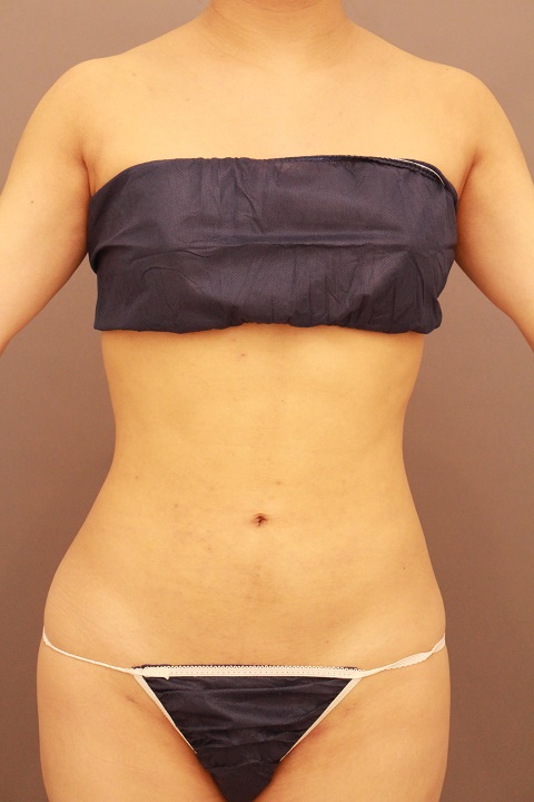 お腹・腰の脂肪吸引 術後3カ月の経過