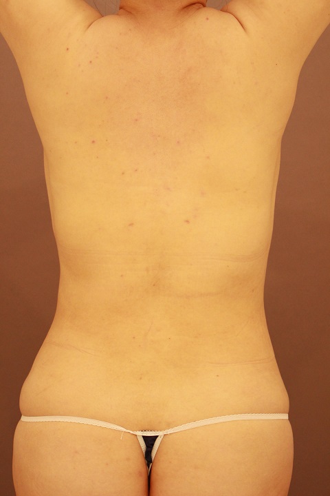 背中・腰の脂肪吸引　術後3カ月の経過