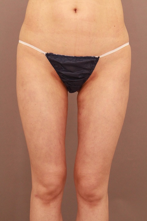 太ももの脂肪吸引　術後3カ月の経過