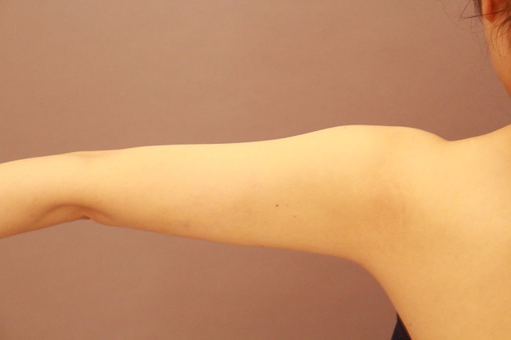 二の腕・肩の脂肪吸引　術後3カ月の経過
