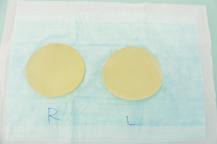 抜去したシリコンバッグ