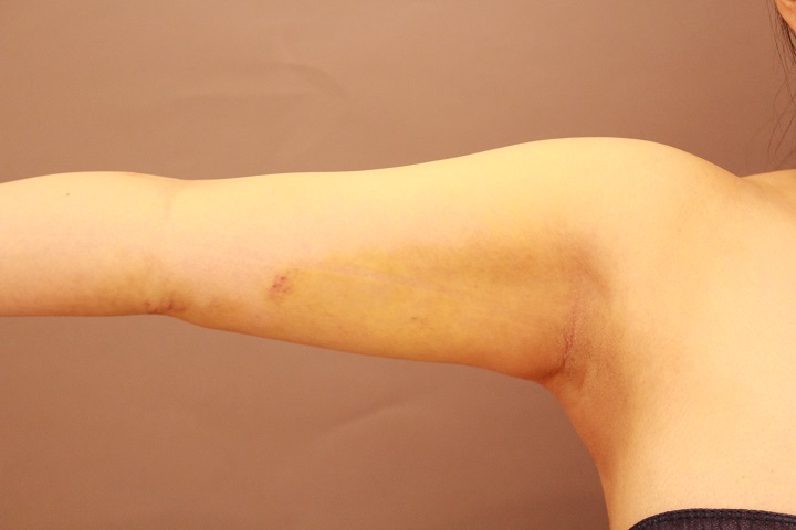 二の腕・肩の脂肪吸引　術後1週間の経過