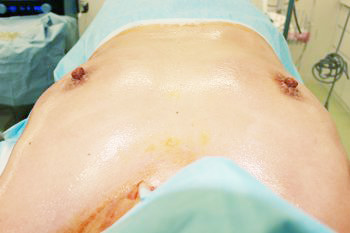 抜去後のバスト