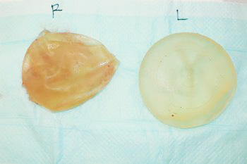 抜去したシリコンバッグ
