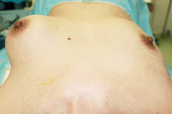 抜去後のバスト