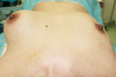 抜去後のバスト