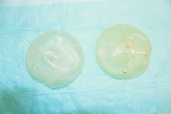 抜去したシリコンバッグ