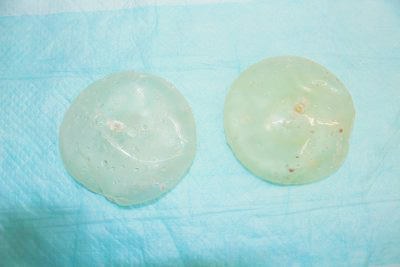 抜去したシリコンバッグ