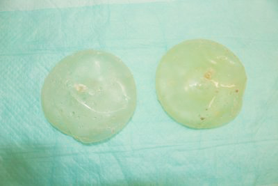 抜去したシリコンバッグ