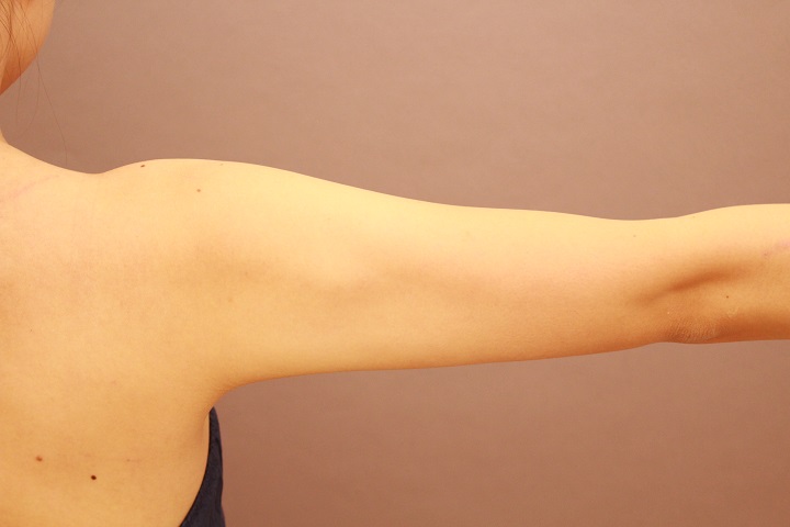 二の腕・肩の脂肪吸引　術後3カ月の経過