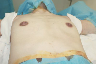 抜去後のバスト