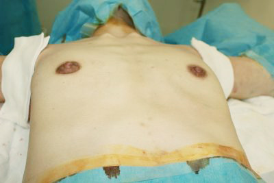 抜去後のバスト