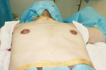 抜去後のバスト