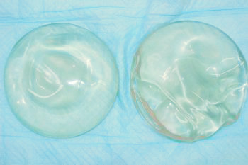 抜去したシリコンバッグ