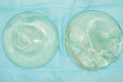 抜去したシリコンバッグ