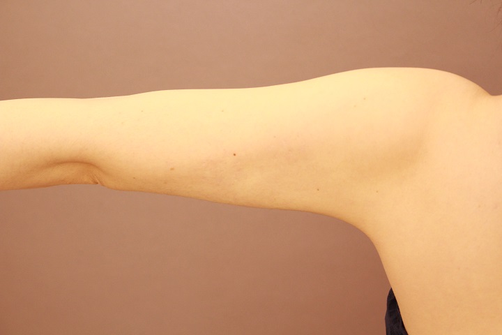 二の腕・肩の脂肪吸引　術後3カ月の経過