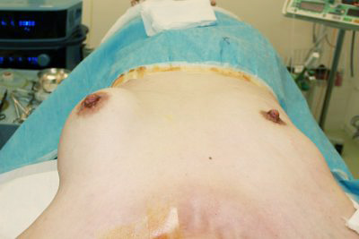 抜去後のバスト