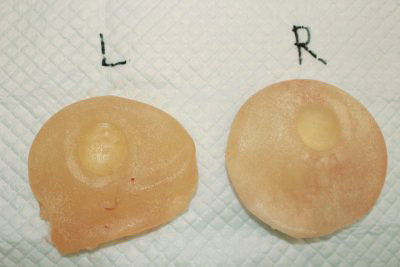 抜去したシリコンバッグ