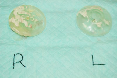 抜去したシリコンバッグ