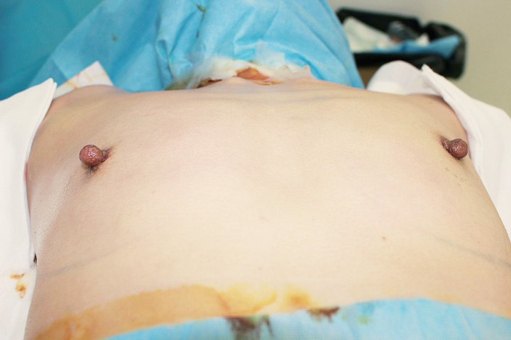 抜去後のバスト