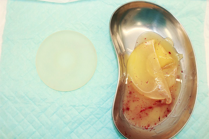 抜去したシリコンバッグ