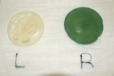 抜去したシリコンバッグ