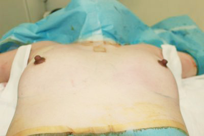 抜去後のバスト