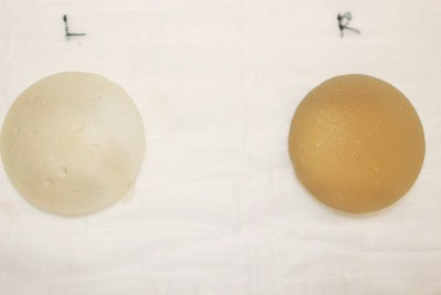 抜去したシリコンバッグ