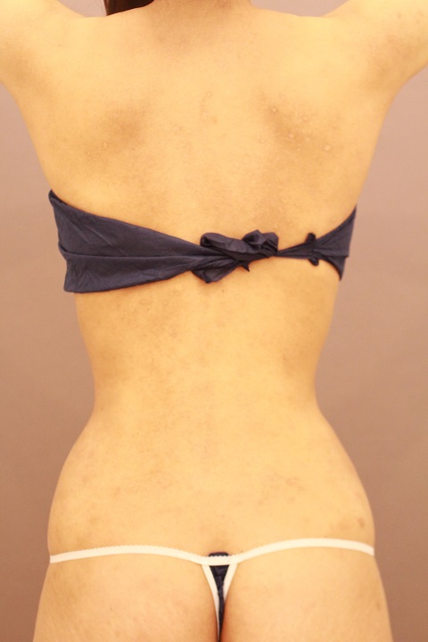 お腹・腰の脂肪吸引 術後3カ月の経過