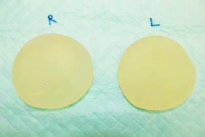抜去したシリコンバッグ