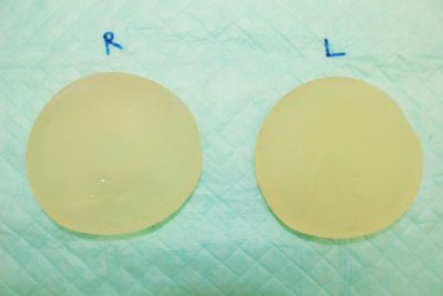 抜去したシリコンバッグ