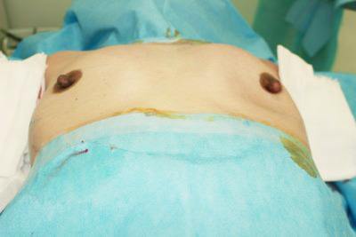 抜去後のバスト