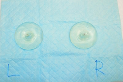 抜去したシリコンバッグ