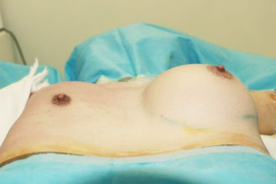 抜去後のバスト