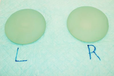 抜去したシリコンバッグ