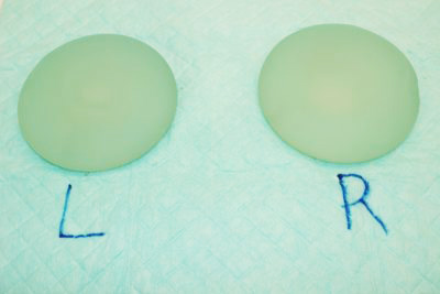 抜去したシリコンバッグ